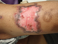 Discoid lupus erythematosus